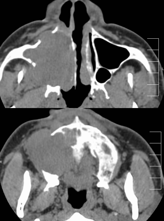 squamous-cell-carcinoma-maxillary-sinus